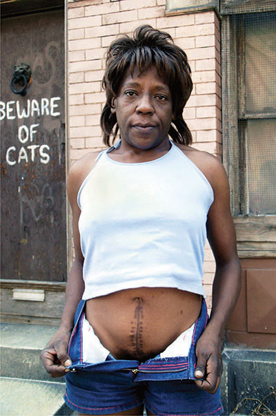 victoria_hysterectomy_scar